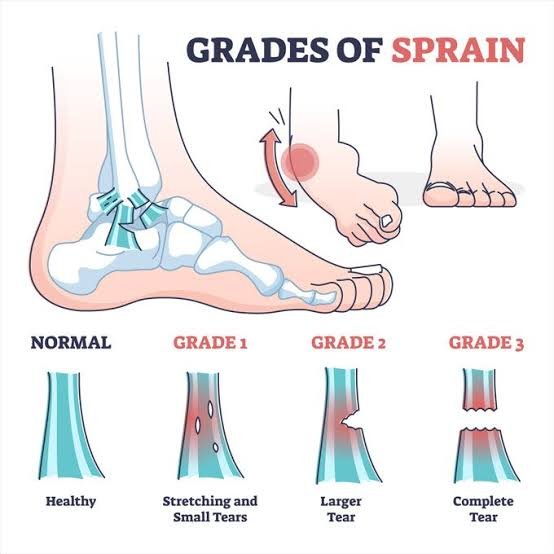 The First 48 Hours After Ankle Sprain: What Pro Athletes Do That You're Not Doing 1 Ankle Sprain