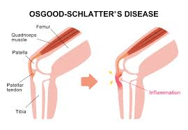 Osgood-Schlatter Disease in Teenage Athletes: Knee Growth Plate Pain and Activity Management Guide 1 Osgood-Schlatter Disease